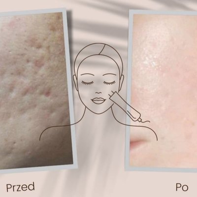 MEZOTERAPIA MIKROIGŁOWA - Głęboka odnowa skóry! Skuteczny zabieg odmładzający, ujędrniający oraz widocznie wygładzający i rozświetlający skórę twarzy. Mezoterapia mikroigłowa jest jednym z najskuteczniejszych zabiegów anty aging w medycynie estetycznej.