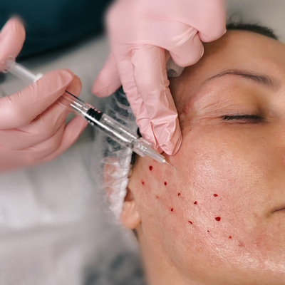 MEZOTERAPIA IGŁOWA - Odkryj Tajemnicę Pięknej Skóry z Mezoterapią Igłową! Czy Twoja skóra potrzebuje odświeżenia i regeneracji? Przyjdź do naszego salonu i daj swojej skórze luksusowy prezent.