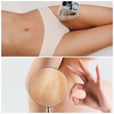 DEPILACJA LASEROWA - Depilacja laserowa bikini lub pach w super cenie! OFERTA LIMITOWANA!