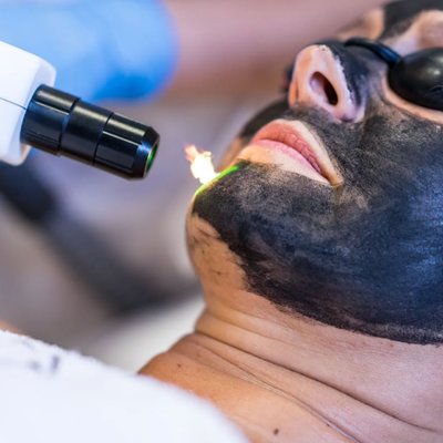 PEELING WĘGLOWY LASEREM PIKOSEKUNDOWYM – Głębokie oczyszczenie, zwężone pory i promienna skóra już po pierwszym zabiegu.