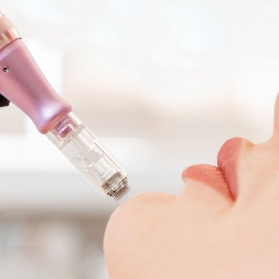 MEZOTERAPIA MIKROIGŁOWA: intensywna regeneracja i odmłodzenie skóry twarzy oraz szyi.