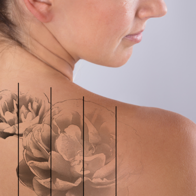 LASEROWE USUWANIE TATUAŻU LUB MAKIJAŻU PERMANENTNEGO BRWI: skutecznie, bezpiecznie i precyzyjnie.