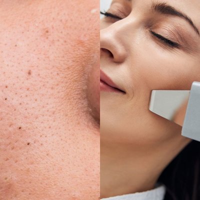 PEELING KAWITACYJNY Z MASKĄ ALGOWĄ: czysta, gładka i promienna skóra – hit sezonu!