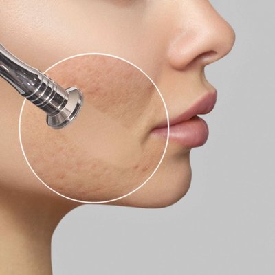 MIKRODERMABRAZJA: wiosenne odświeżenie skóry – gładka, czysta i promienna cera gotowa na nowy sezon.