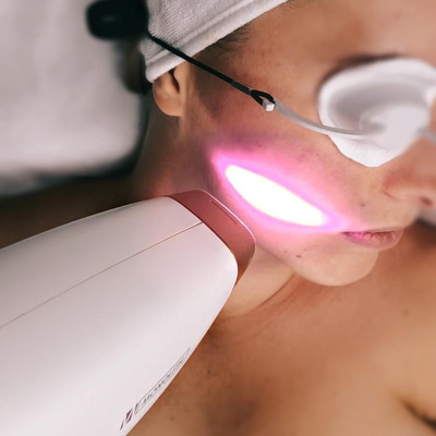 ZABIEG LASEROWY NA NIEDOSKONAŁOŚCI SKÓRY: wyciszenie rumienia, redukcja przebarwień, zmian trądzikowych i widoczne odmłodzenie cery w jednym zabiegu.