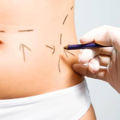 TECAR NA BRZUCH: widocznie jędrniejsza skóra, wygładzenie i modelowanie sylwetki – brzuch bardziej napięty i smukły już po pierwszym zabiegu.