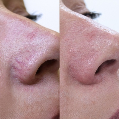 USUWANIE NACZYNEK ELEKTROKOAGULACJĄ: zamknięcie naczynek i wyraźnie czystsza, jednolita skóra już po zabiegu.